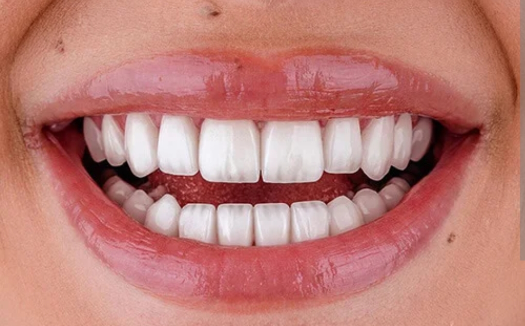 لمینت سرامیکی