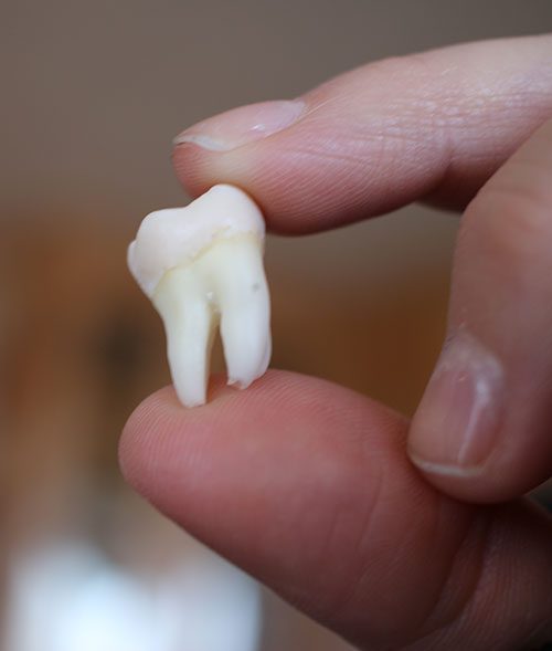 توصیه‌های بعد از کشیدن دندان