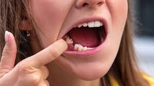 اولین «داروی رشد مجدد دندان» در جهان وارد فاز آزمایش بالینی می‌شود