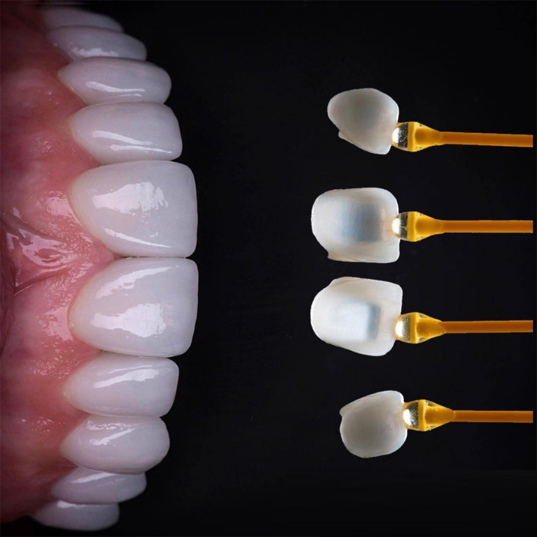 توصیه های بعد از لمینت سرامیکی